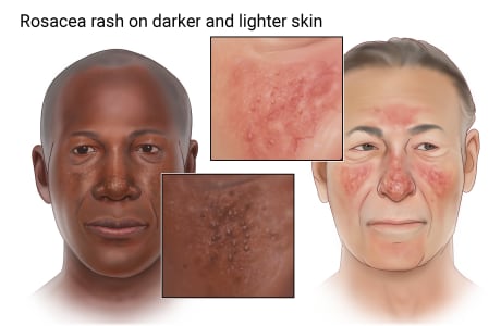Rosecea rash on darker and lighter skin.