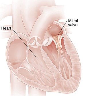 Cross section of heart showing mitral valve stenosis.