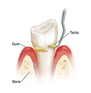 Side view of tooth in bone with instrument doing scaling of tartar..