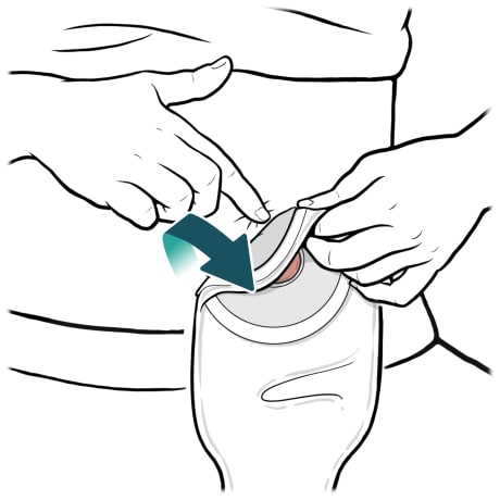 Person peeling ostomy bag down and away from stoma on belly.