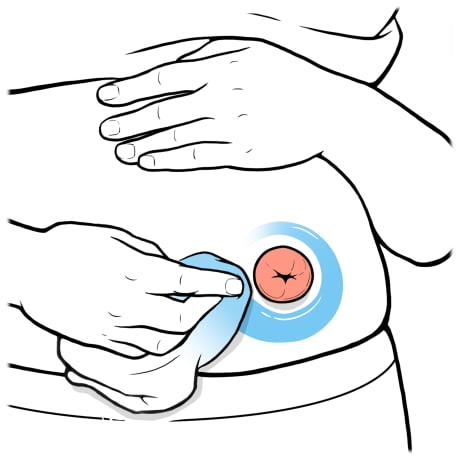 Person holding shirt up with one hand and other hand wiping skin around stoma with wet cloth.