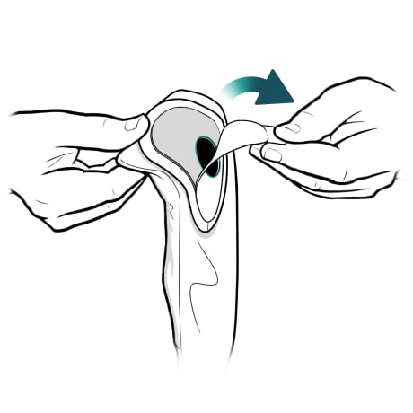 Person peeling back adhesive layer from front of ostomy bag.