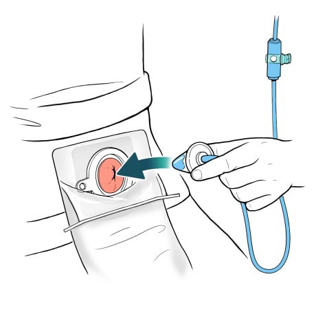 Arrow showing person placing cone into stoma with water in tube and clamp closed.