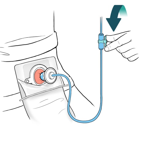 Cone tip in stoma and person twisting handle on clamp to the left to open.