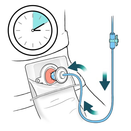 Cone tip in stoma and arrows showing water flowing through tube and into stoma with clock showing time passing.
