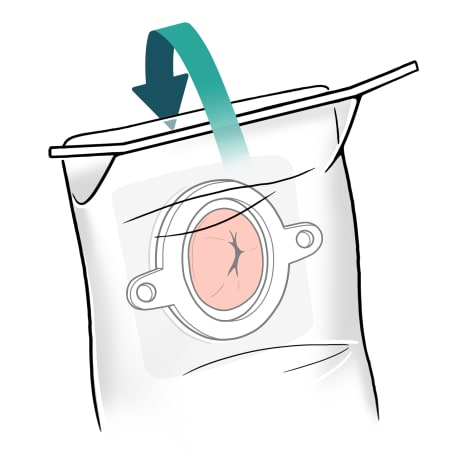Arrow showing sleeve top near stoma is folded over wire and toward body.