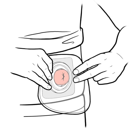 Person placing small pouch over skin barrier and stoma.