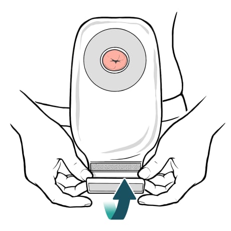 Ostomy bag on stoma with person closing end of ostomy bag.