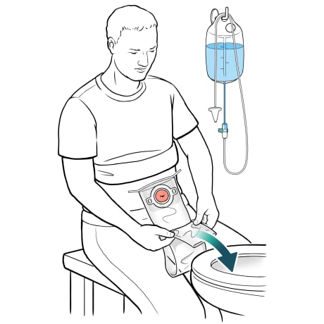 Person sitting next to toilet near hanging water bag with arrow showing irrigation sleeve opening in toilet.