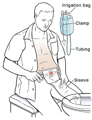 Man sitting next to toilet with end of ostomy bag over edge of toilet bowl. Irrigation bag and tubing hang from hook on wall.