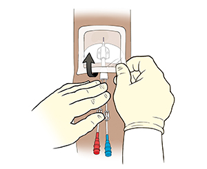 Midline catheter in arm, with a gloved hand holding catheter while other gloved hand pulls up corner of dressing.