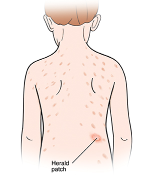 Rash on child's back with one large spot of herald patch.