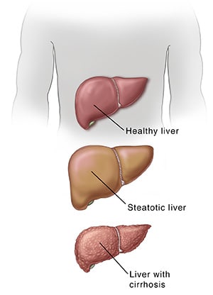 A healthy liver, a fatty liver, and a liver with cirrhosis.