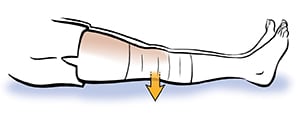 Leg with bandage on knee,  showing person doing  quadriceps sets.