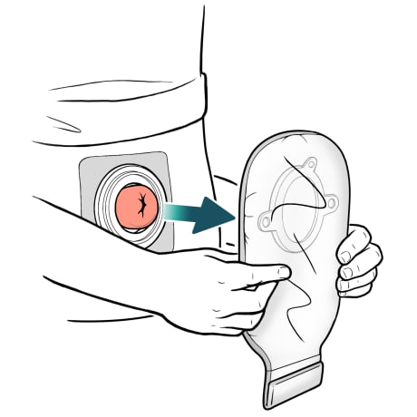 Person removing pouch by pulling it away from stoma.