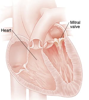 Cross section of heart showing mitral valve insufficiency. 