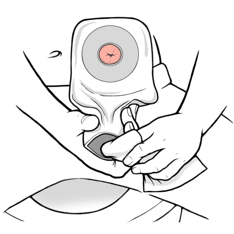 Person using toilet paper to wipe inside and outside of ostomy bag opening.