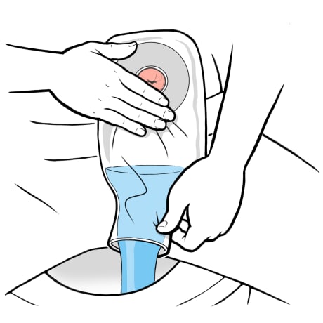 Person sitting on toilet with hand holding ostomy bag opening over toilet bowl and water draining out.