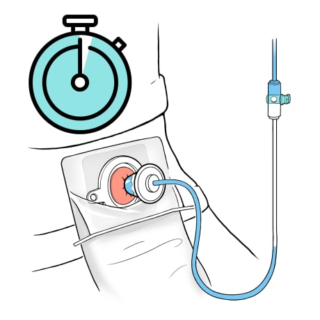 Cone in stoma and water draining from tube with stopwatch showing time passing.