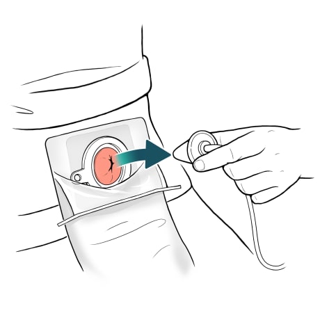 Cone being pulled away from stoma.