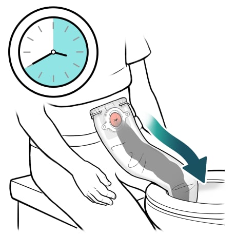 Person sitting next to toilet with irrigation sleeve opening in toilet and stool flowing out and into toilet with clock showing time passing
