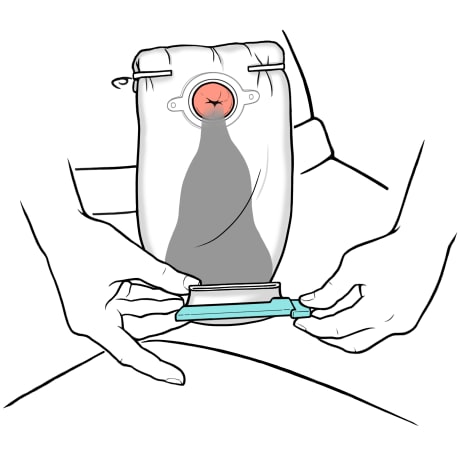 Person holding end of irrigation sleeve with one hand and closing clamp with other hand.