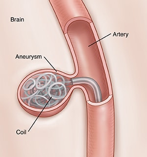 Closeup of embolization, showing metal coil being placed in brain artery aneurysm.