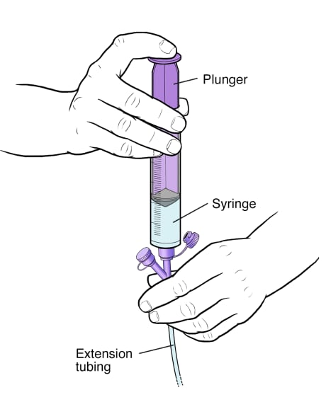 Plunger of syringe being pushed to move water into extension tubing to flush feeding tube.
