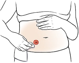 Closeup of abdomen showing hands cleaning around stoma.