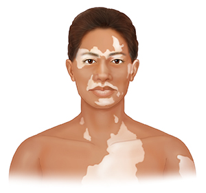 Front view of head and shoulders with light patches of skin on face, neck, and chest.