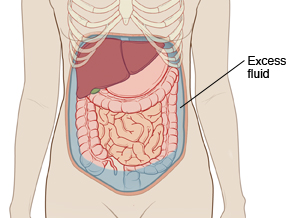 Outline of abdomen showing abdominal organs. Fluid is filling abdomen around organs. 