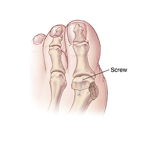 Top view of big toe showing screw holding bones together after bunion chevron head osteotomy.