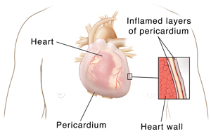 Heart in chest, showing pericardium with detail of inflamed layers of pericardium around heart wall.