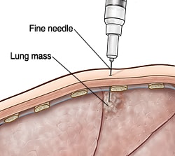 Cross section of body wall showing needle taking tissue sample from lung mass.