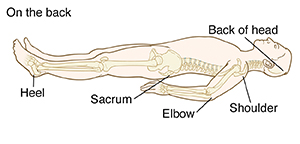Person lying on back, showing areas where pressure injuries happen, at back of head, shoulder, elbow, sacrum, and heel.