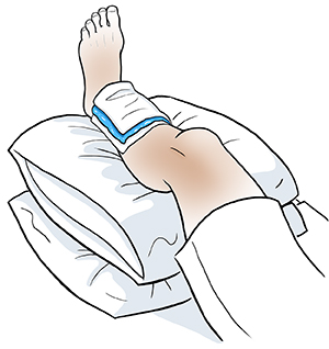 Leg elevated on pillows with ice pack wrapped in thin towel on shin.