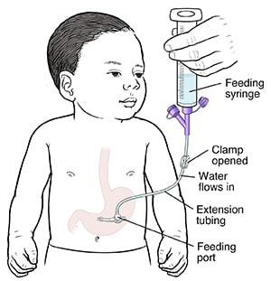 Flushing child’s G or G-J tube using syringe, extension tubing, and water flowing into stomach.