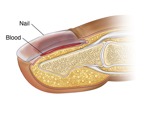 Cross section of fingertip showing blood under fingernail.