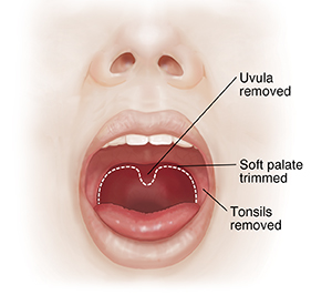 Front view of face showing open mouth. Dotted line shows soft palate tissues to be removed.