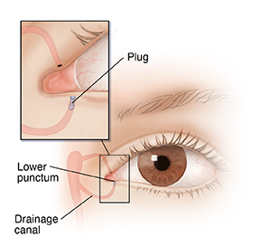 Front view of eye showing plug in drainage system of eye.