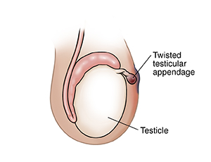 Side view of testicle showing twisted testicular appendage.