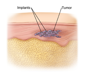 Cross section of skin showing tumor with 13 tiny pellets inside..