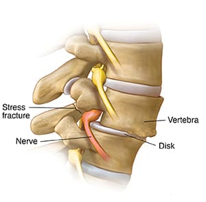 Side view of lumbar spine showing spondylolisthesis and stress fracture.
