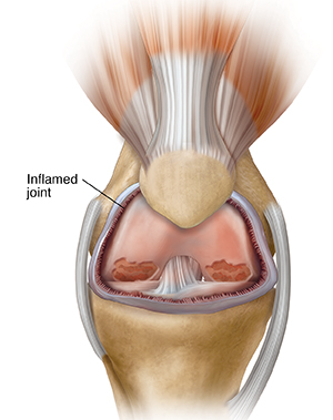 Front view of knee joint showing inflammation and arthritis.