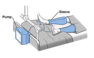 Patient in hospital bed wearing sequential compression sleeves on legs.