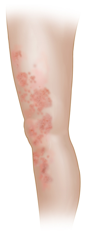 Rash on light-skinned leg.