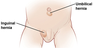 Lower abdomen of male baby showing location in groin of inguinal hernia and location near belly button of umbilical hernia.