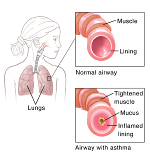 Outline of child showing lungs. Insets show normal airway and airway with asthma.