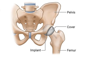 Bones of the hip joint, showing an implant and metal cover on the femoral head.