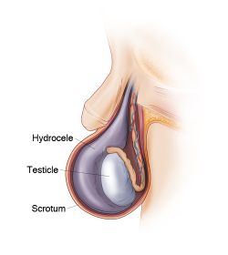 hidrocele